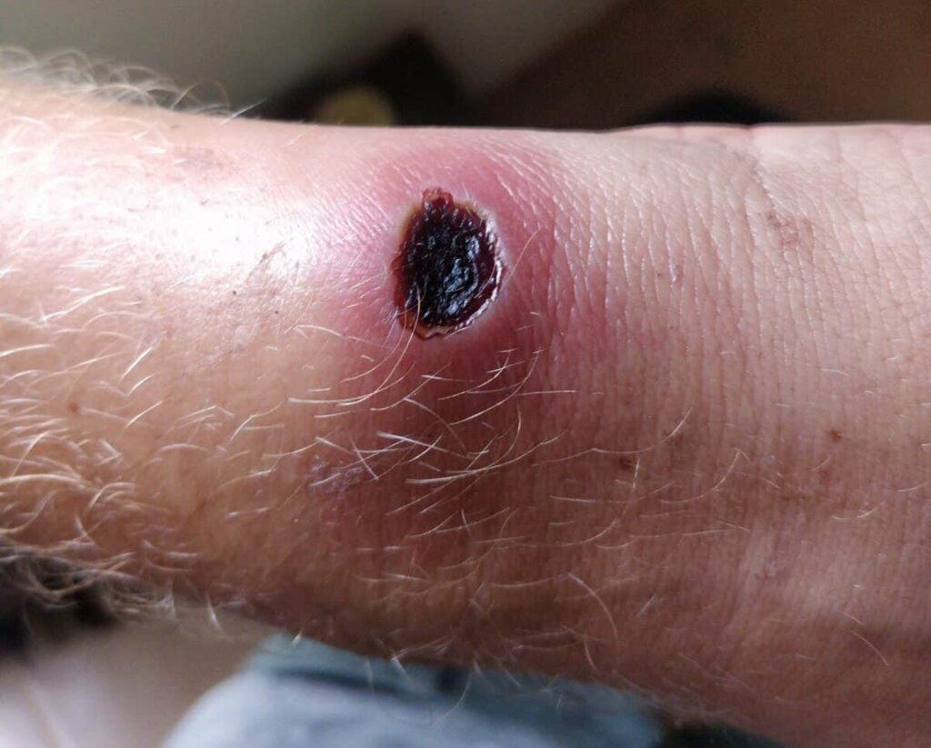 Black salve on Leishmaniasis