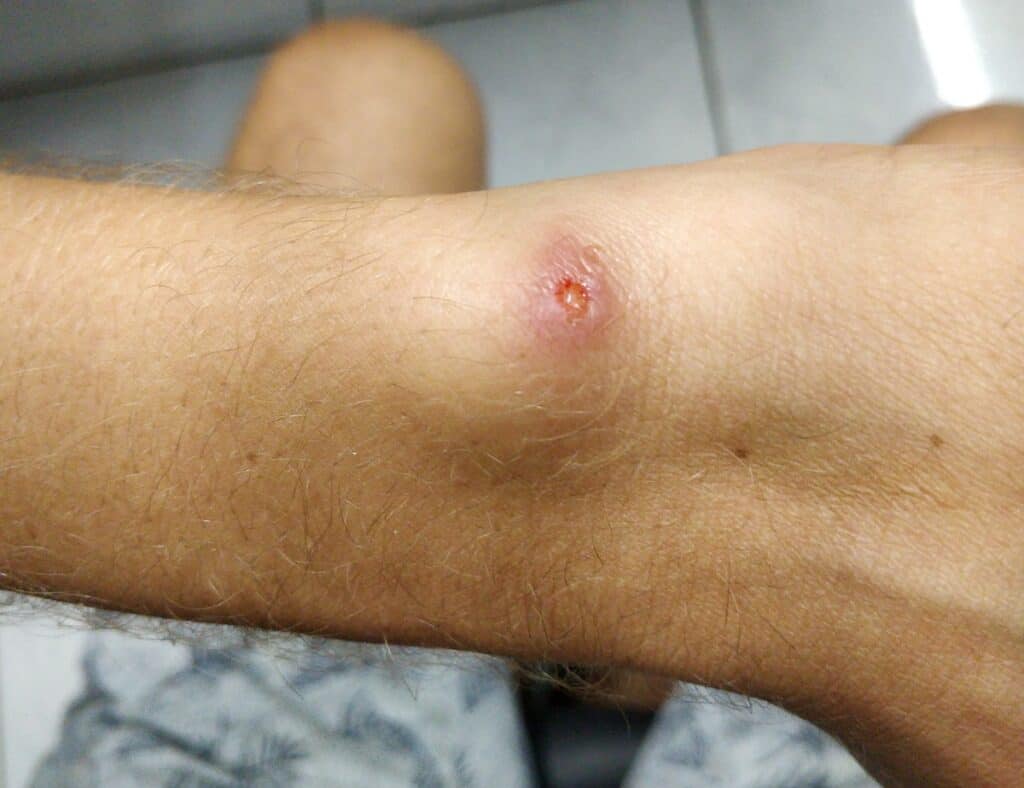 The beginning when my leishmaniasis appeared